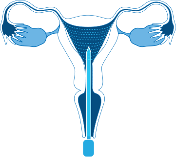 Endometrial (Thermal) Ablation