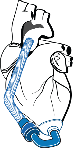 Ventricular Assist Device (VAD)